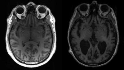 Wissenschaftler gewinnen neue Erkenntnisse zum Verlauf von Alzheimer