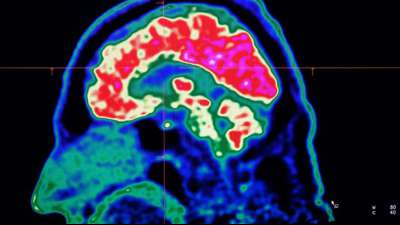 Ein milder Covid-19-Verlauf kann auch zu Gehirnschäden führen
