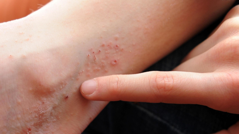 Dermatologi, 'riconoscere il prurito cronico come priorit&agrave; clinica'